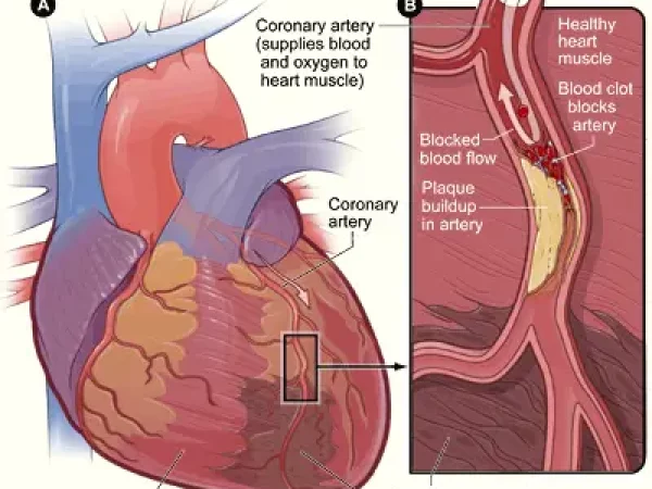 Heart_attack-NIH